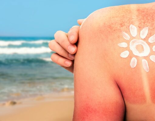 ¿Por qué la quemadura de sol aparece tardíamente? quemadura