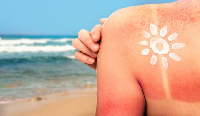 Woman,With,Sunburned,Skin,On,Beach,,Back,View.,Soothing,Cream quemadura