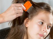 ¡5 tratamientos para eliminar los piojos para siempre! tratamientos piojos