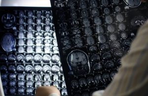 Ataque cerebral. ¿Quiénes son más vulnerables? Revista Selecciones