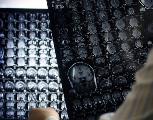 Ataque cerebral. ¿Quiénes son más vulnerables?