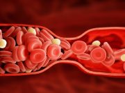 ¿Qué son los cristales de colesterol?