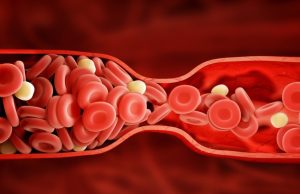 ¿Qué son los cristales de colesterol? Revista Selecciones