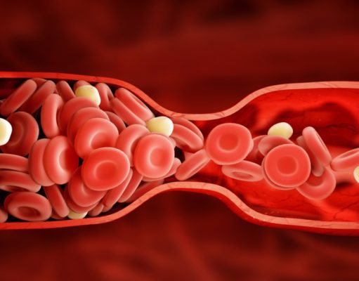 ¿Qué son los cristales de colesterol?