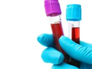 Hepatitis: ¿quién corre riesgo? Revista Selecciones