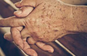 La solución contra las manchas de la edad Revista Selecciones