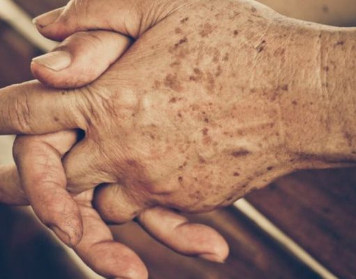 La solución contra las manchas de la edad