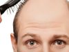 ¿Qué hacer contra la caída de pelo hereditaria? caida de pelo