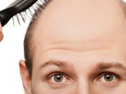 ¿Qué hacer contra la caída de pelo hereditaria? caida de pelo