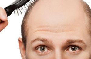 ¿Qué hacer contra la caída de pelo hereditaria? caida de pelo