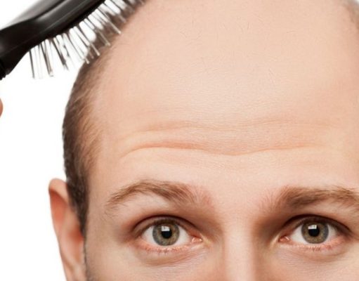 ¿Qué hacer contra la caída de pelo hereditaria? caida de pelo