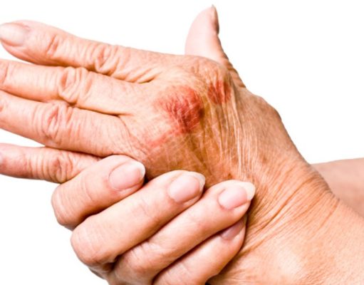 Vivir con lupus