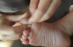 Primeros auxilios: ¿Cómo quitar astillas de forma casera? Revista Selecciones