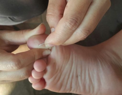 Primeros auxilios: ¿Cómo quitar astillas de forma casera?