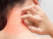 ¿Cuáles son los síntomas comunes de la alergia?