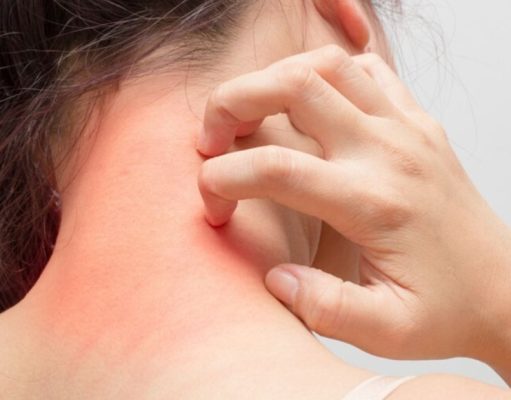 ¿Cuáles son los síntomas comunes de la alergia?