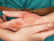 6 pasos sencillos para curar quemaduras en la piel quemaduras