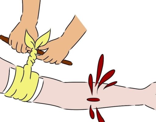 ¿Cómo actuar ante un sangrado profuso?