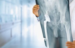 Dolor de cadera: Estrategias clave para la prevención Revista Selecciones