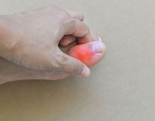 ¿Qué es la gota y cómo se previene?