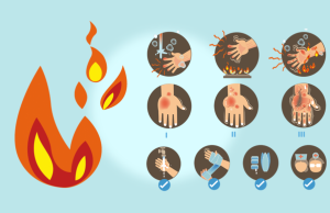 Quemaduras: síntomas y consejos para curarlas Revista Selecciones