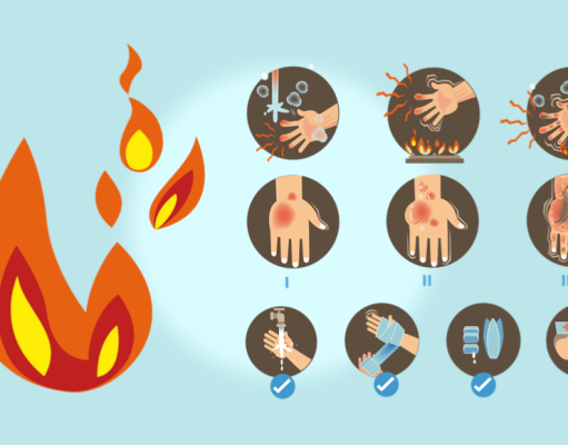 Quemaduras: síntomas y consejos para curarlas