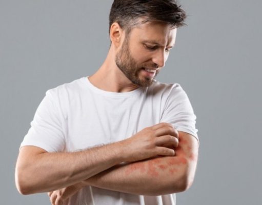 Tratamientos caseros para aliviar los eccemas