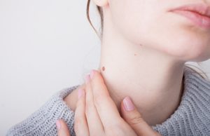 Adiós, verrugas Cómo eliminar esas feas protuberancias cutáneas y olvidar a las verrugas.