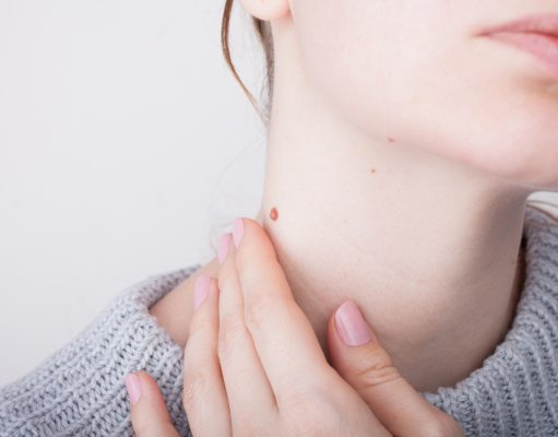 Adiós, verrugas Cómo eliminar esas feas protuberancias cutáneas y olvidar a las verrugas.